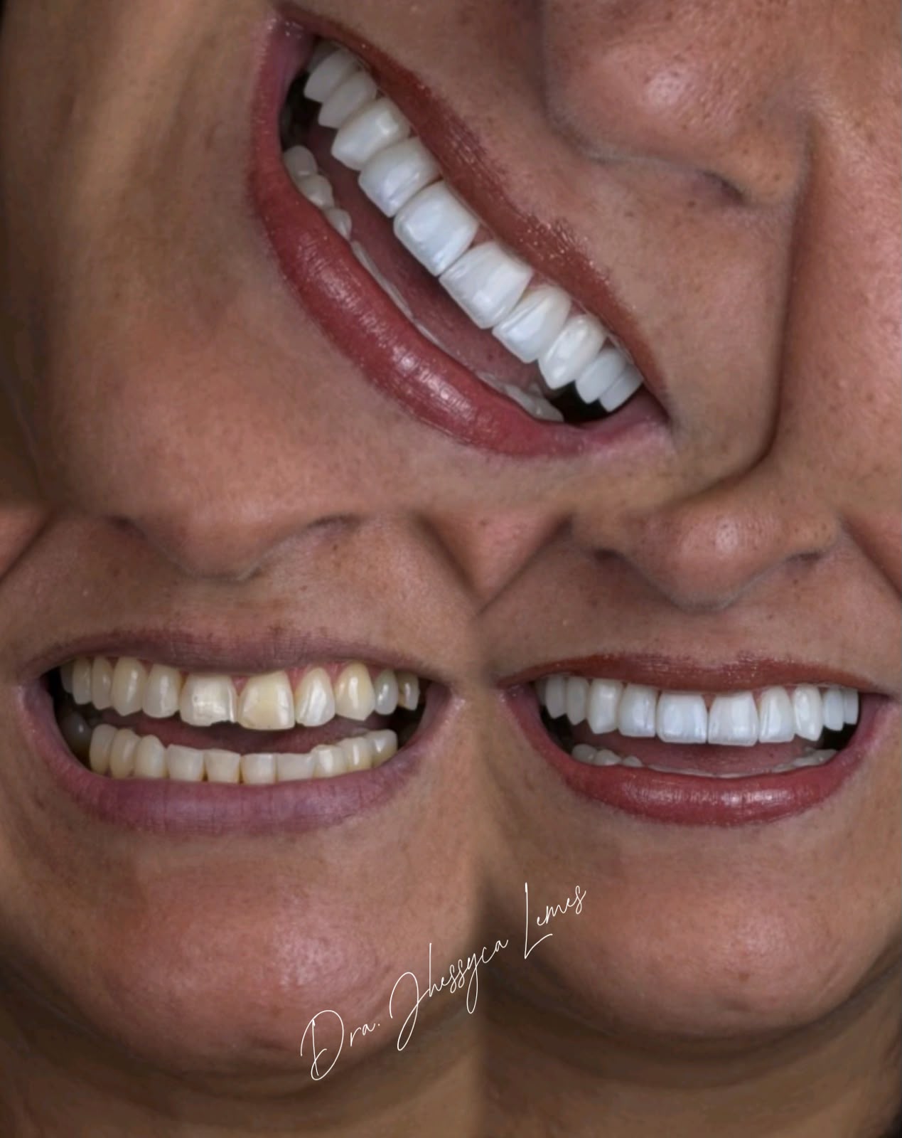 Detalhe de sorriso reabilitado com lentes, caso realizado pela Dra. Jhessyca Lemes